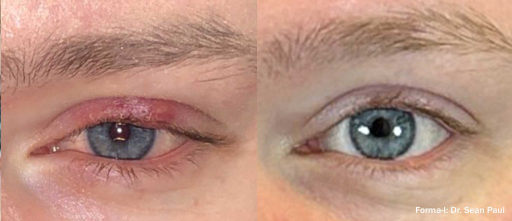 SP Forma I BeforeAfter 1 TM